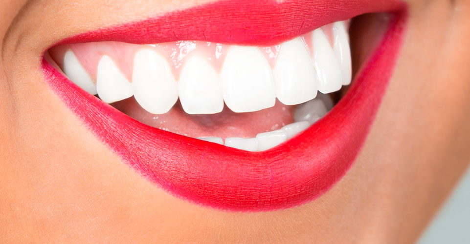 Blanqueamiento dental