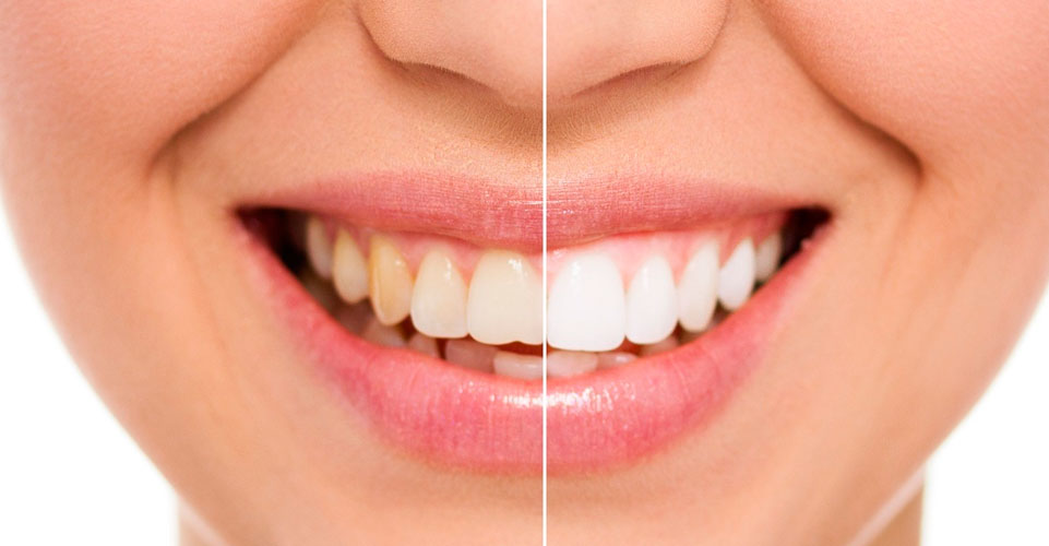 Estética dental