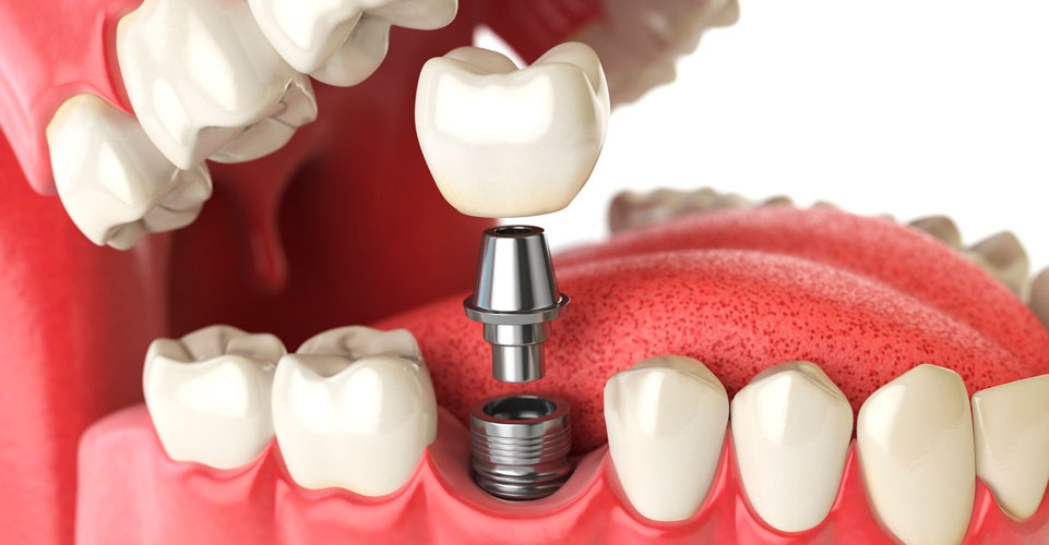 Implantes dentales en Mondoñedo